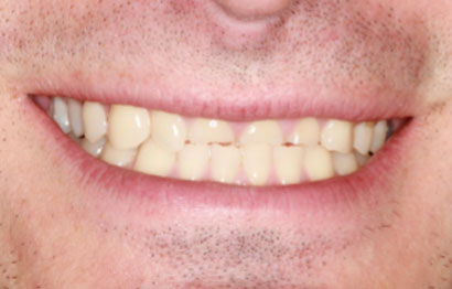 Upper and Lower Crowns and Veneers to Correct the Bite