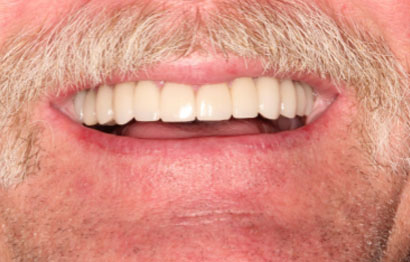 Upper and Lower Crowns and Veneers