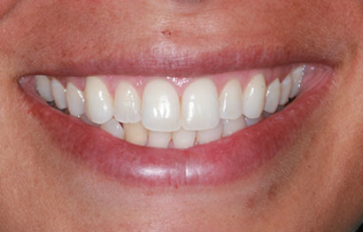 Porcelain Veneers Upper and Lower, Laser Gum Reshaping
