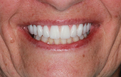Upper Implant supported Teeth-in-a-Day