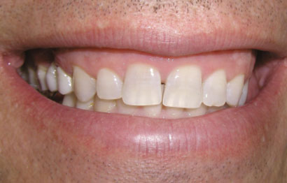 Upper and Lower Crowns and Veneers, Gum Recontouring