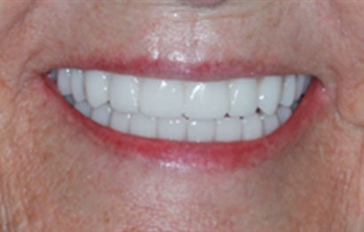 Upper and Lower Teeth In A Day Dentures