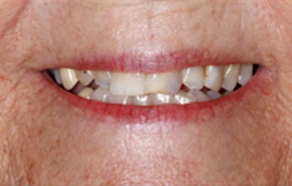 Upper and Lower Teeth In A Day Dentures