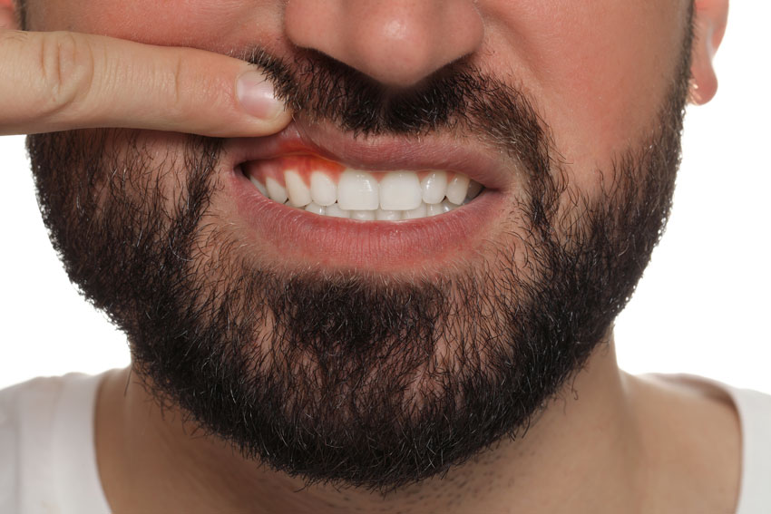 up close of man with inflamed gums